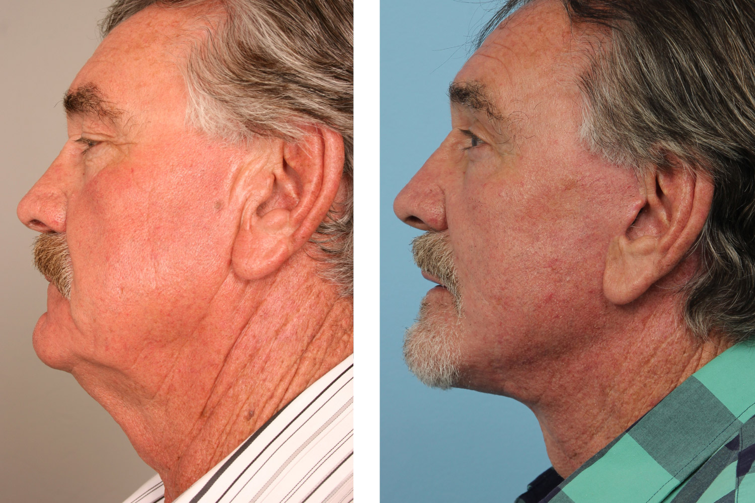 Complex neck lift and lower face lift on a 70-year-old man