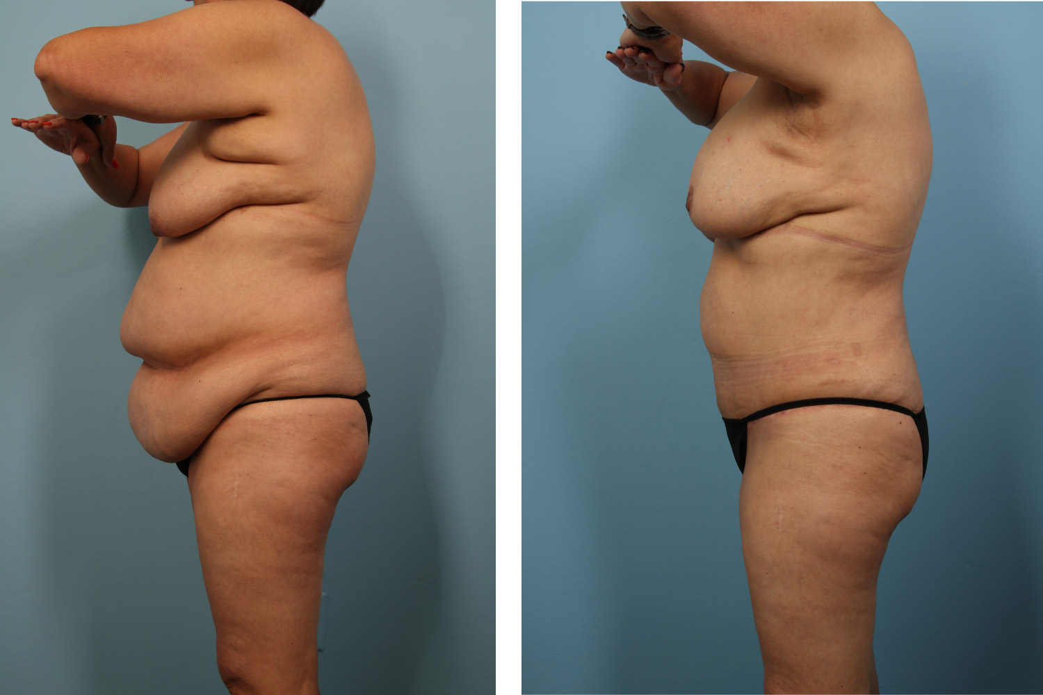 Mommy makeover on a 60-year-old woman including tummy tuck, liposuction, and breast augmentation