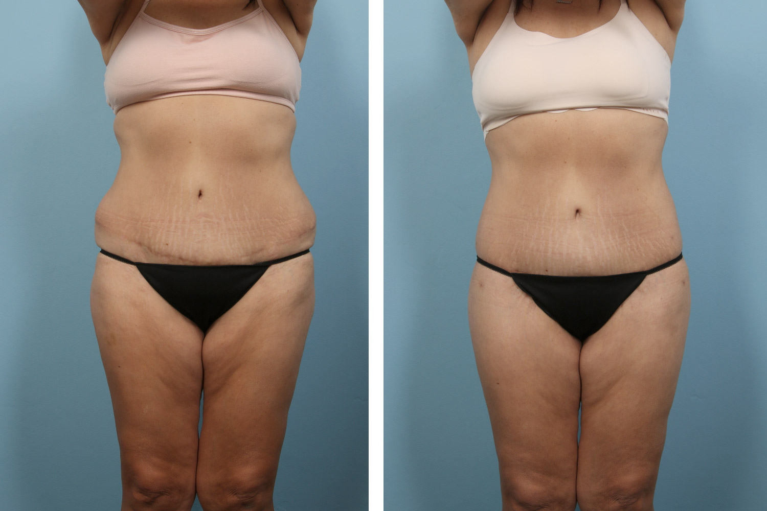 Tummy tuck with buttock lift and liposuction on a 55-year-old woman