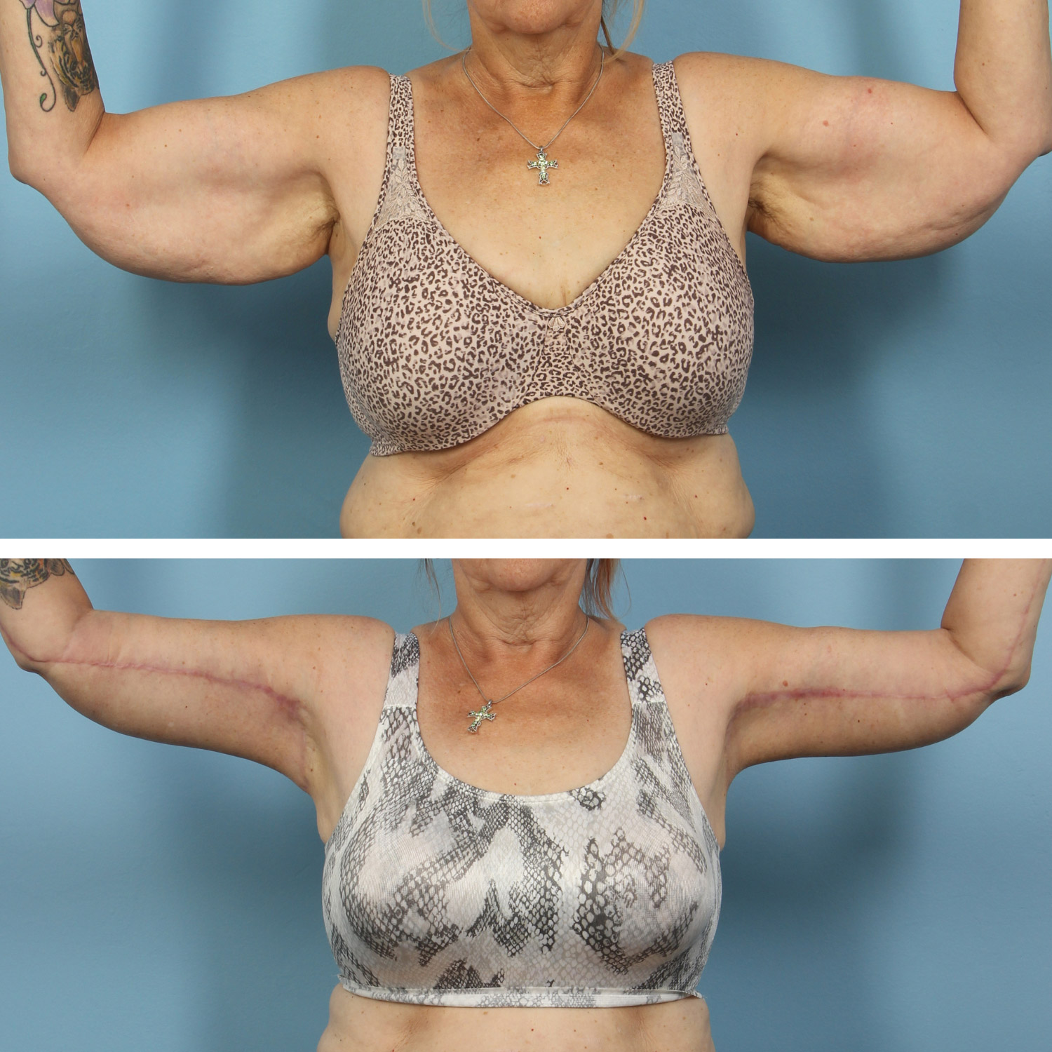 Bilateral brachioplasty (arm lift) on a 60-year-old woman