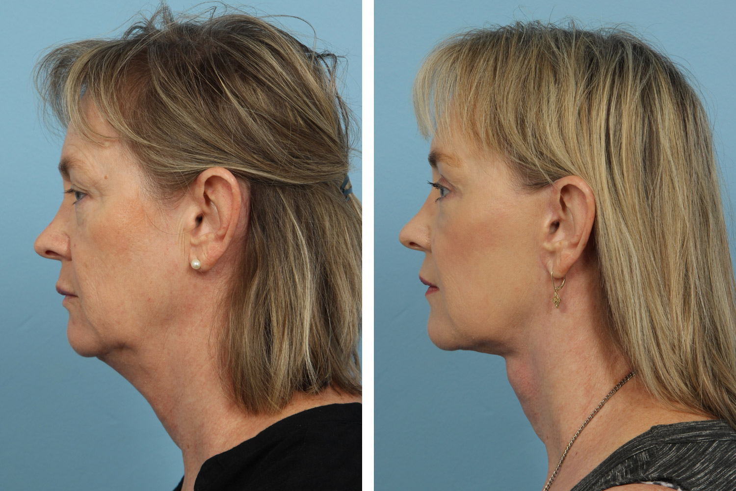 Facelift with fat injections, browlift, corrugator removal, upper and lower blepharoplasties, and laser resurfacing on a 60-year-old woman