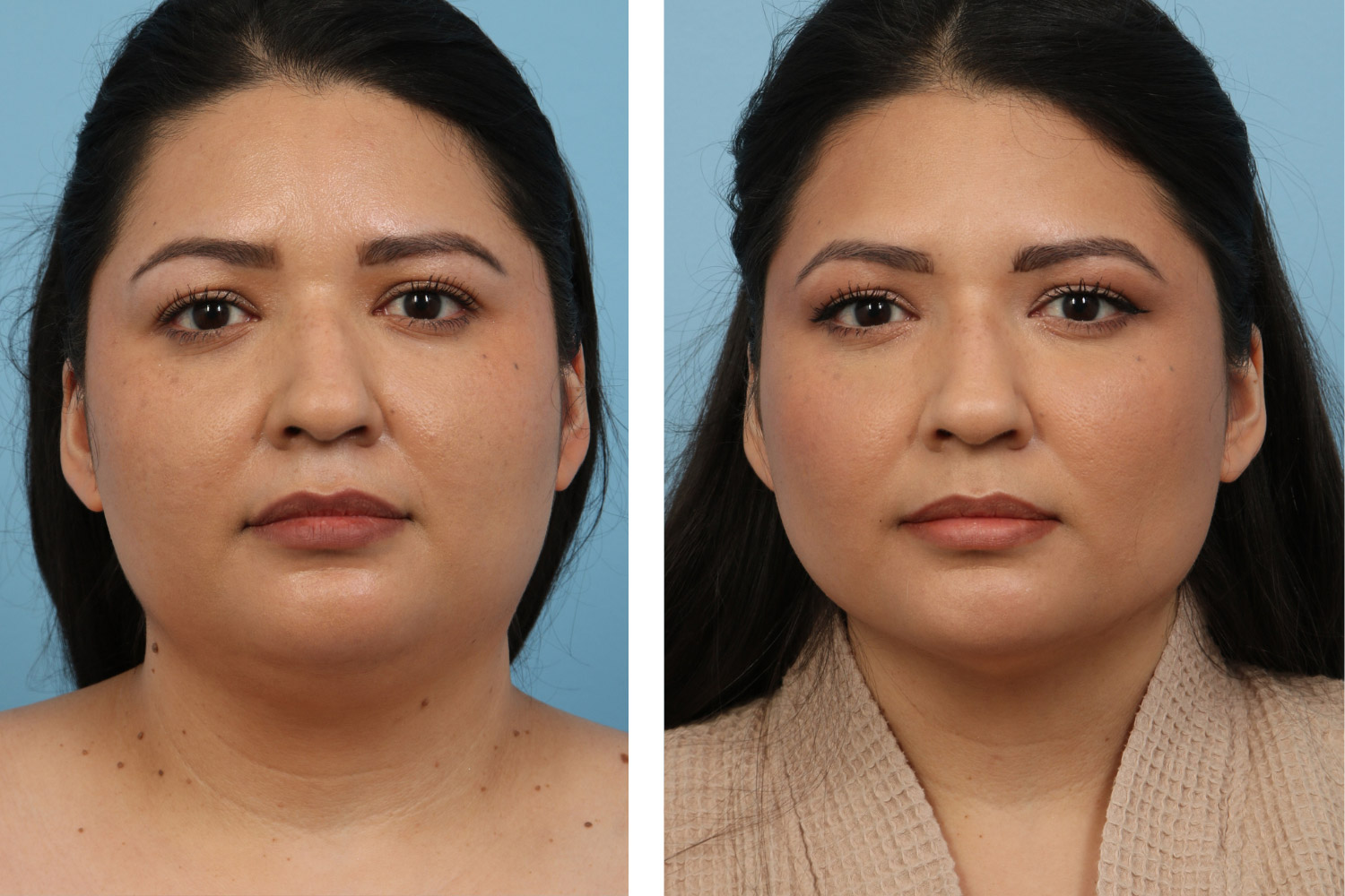 Neck liposuction procedure on a 30-year-old woman
