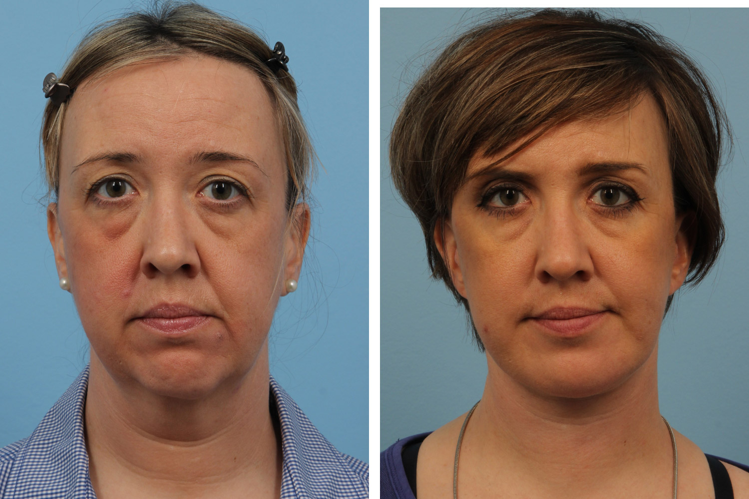 Complex neck lift, chin implant, upper and lower blepharoplasty, and fat injections on a 40-year-old woman